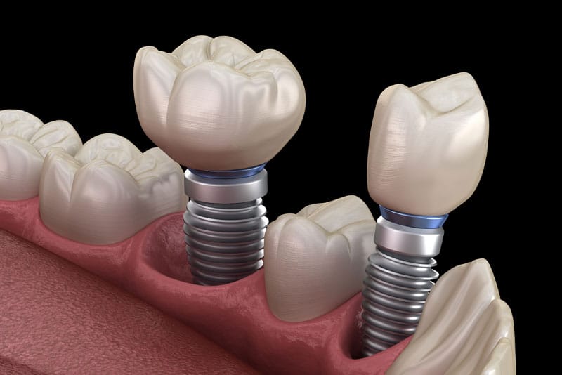 Illustration of a Single Dental Implant Model
