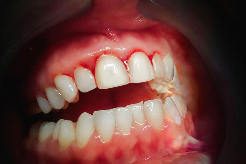 Dental Patient Suffering From Gum Disease