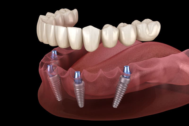Illustration of an All-On-4 Dental Implant Model With A Full Mouth Dental Implant Restoration