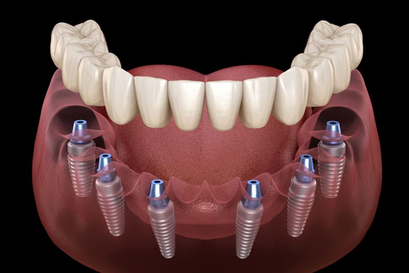 Illustration of our new Smile Today Same Day Dental Implant Graphic