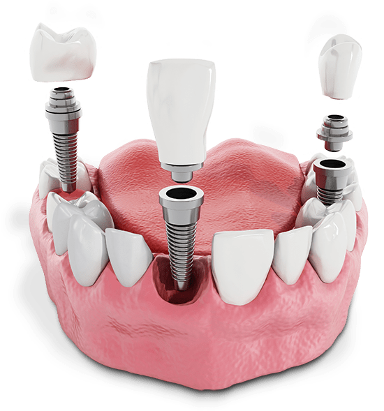 Illustration of Multiple Dental Implants Model