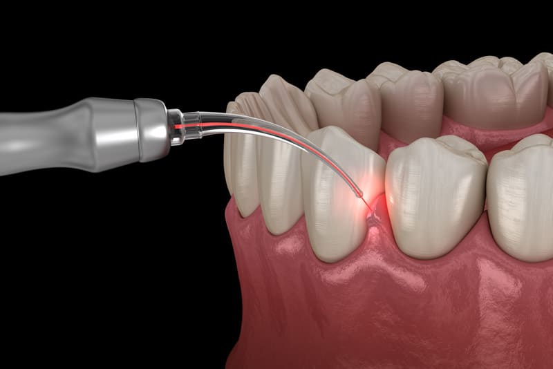 Illustration of Periodontal Laser Being Used On Gums
