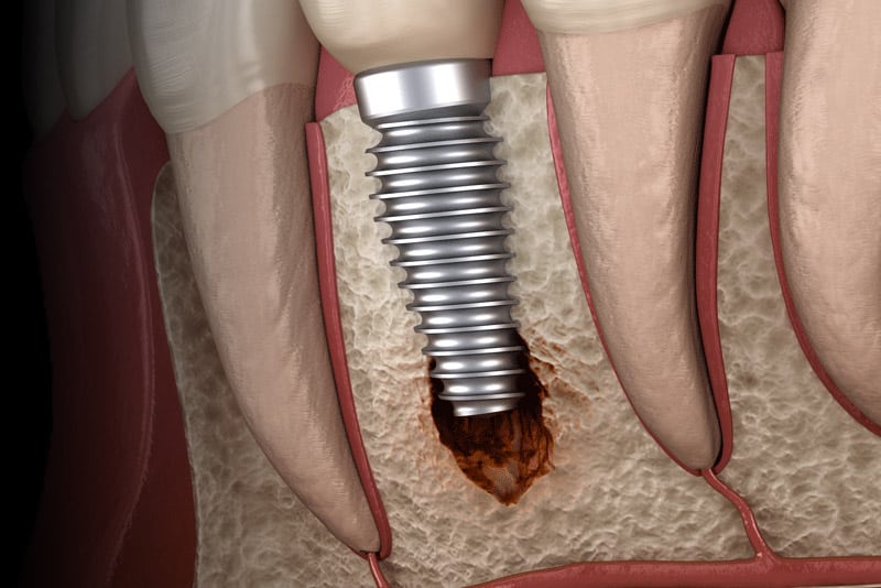 Illustration Single Dental Implant With Complication Suffering From Peri-Implantitis