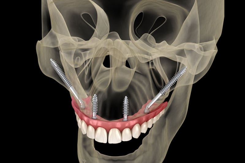 Illustration of zygomatic dental implants.