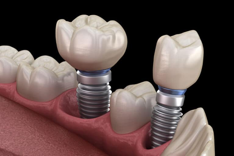 a digital model of a lower jaw showing two dental implant posts.