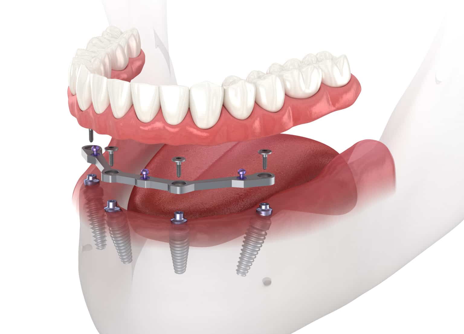 Periodontist vs. Oral Surgeon for Dental Implants Advanced Oral