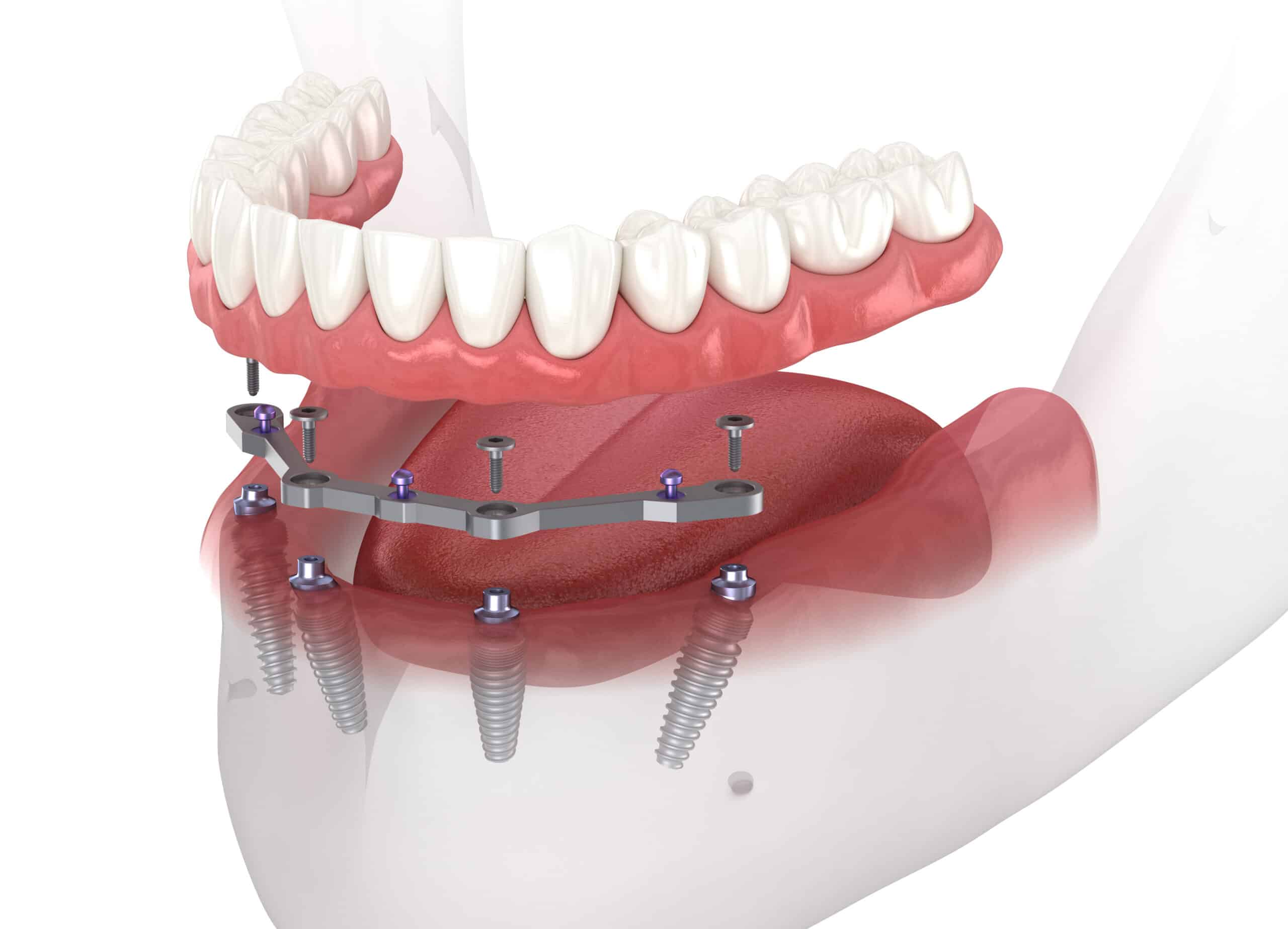 a 3D image od dental implants in Voorhees, Township, NJ.