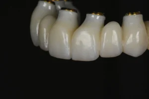 An example of what an FP1/FP2 restoration arch looks like